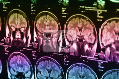 Crema News - Collegamento tra coronavirus e problemi al tessuto cerebrale